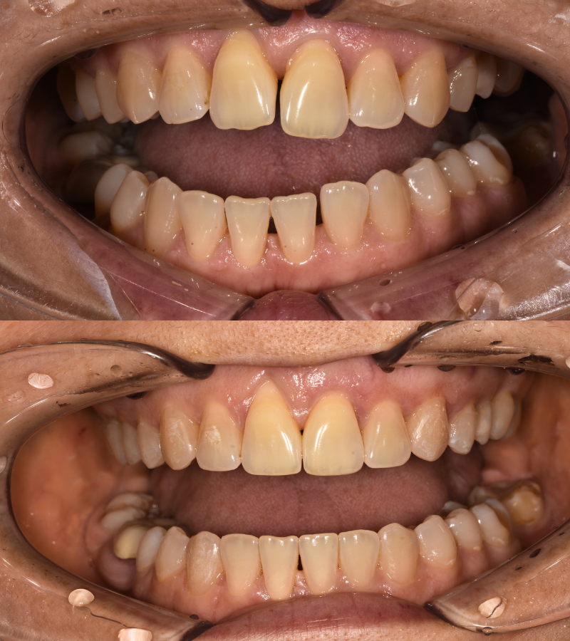 angel aligner before & after 1