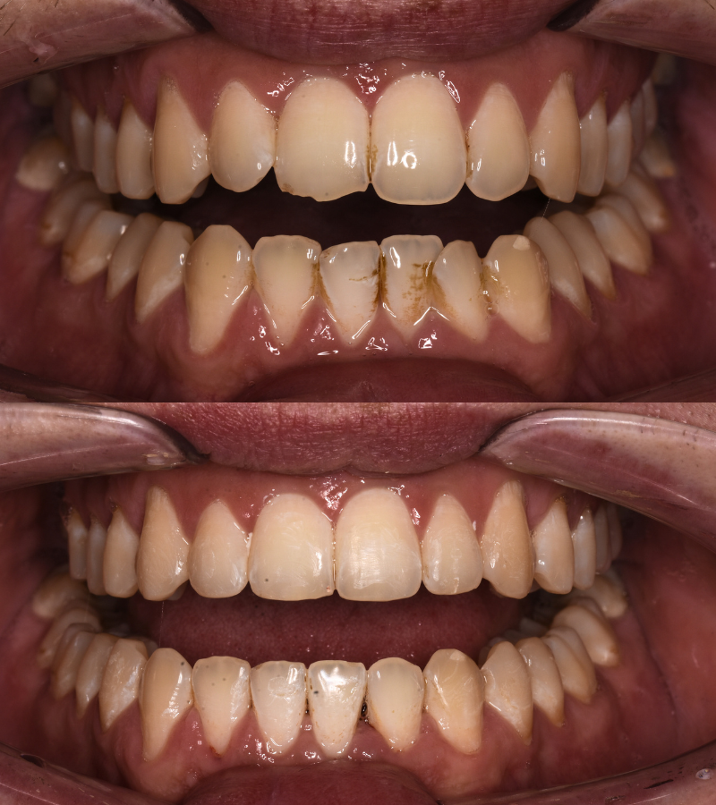 angel aligners before & after 2