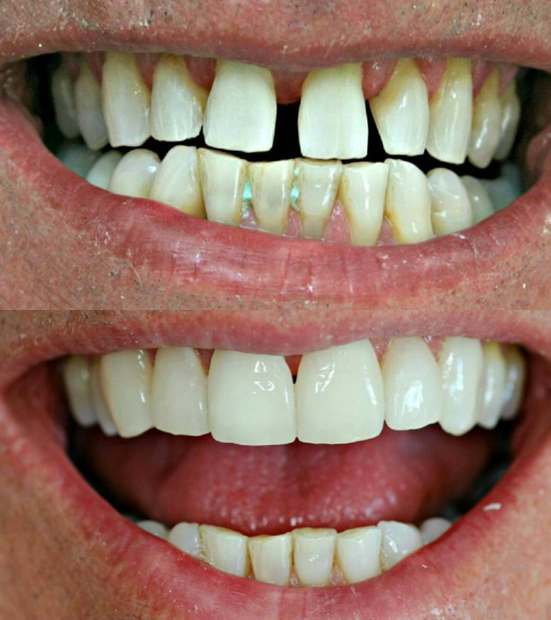 before after veneers