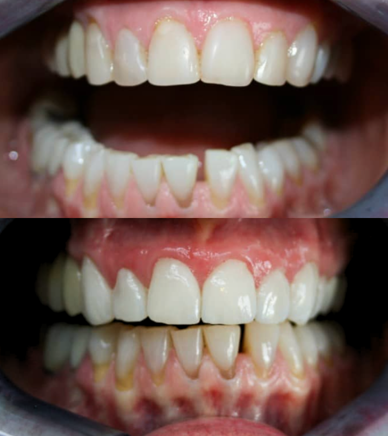 before and after veneers