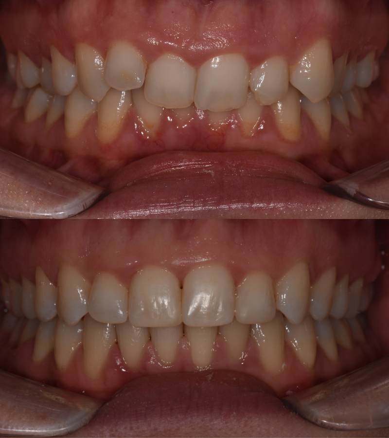 damon braces b&a 1