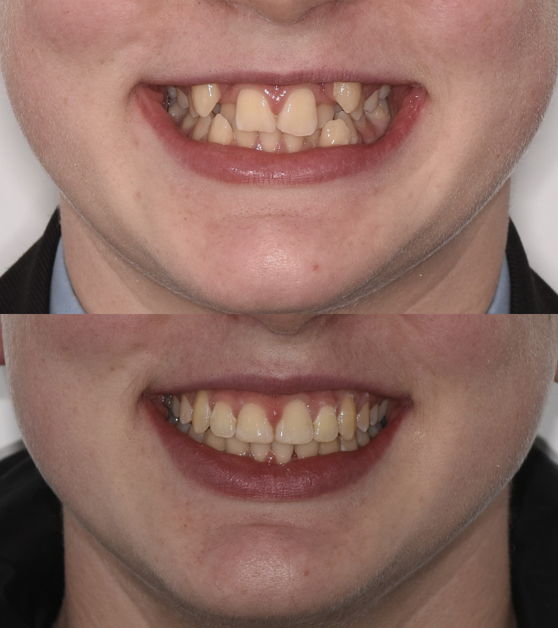 damon braces b&a 2