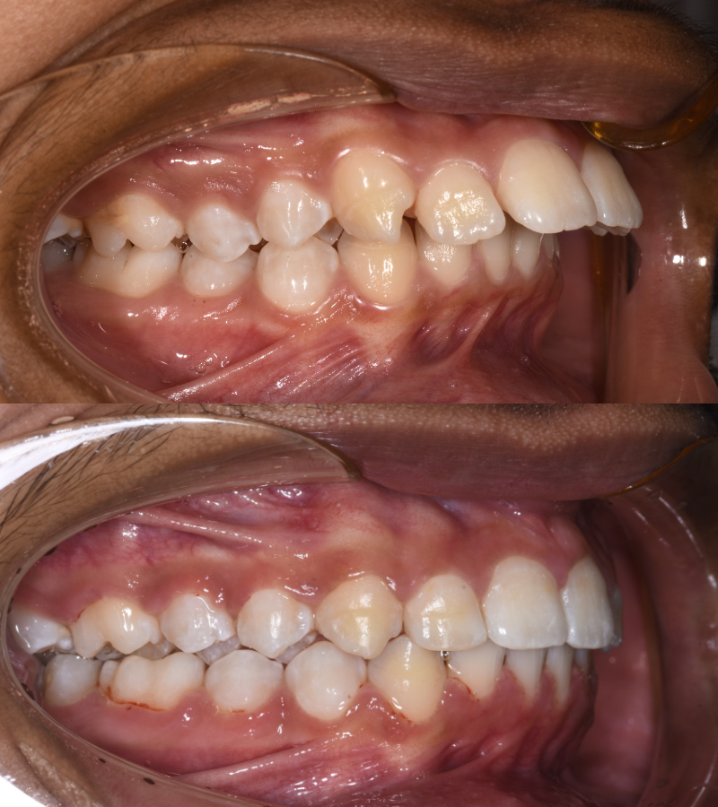 damon braces b&a 3