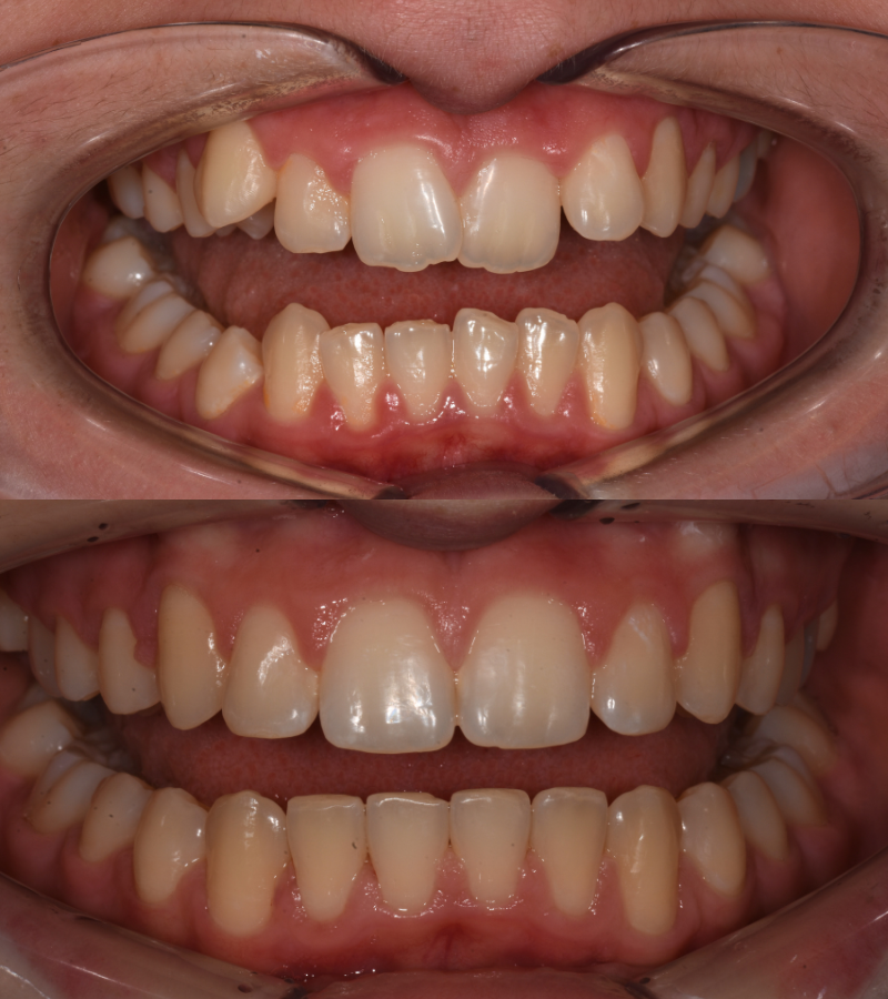 damon braces b&a 4