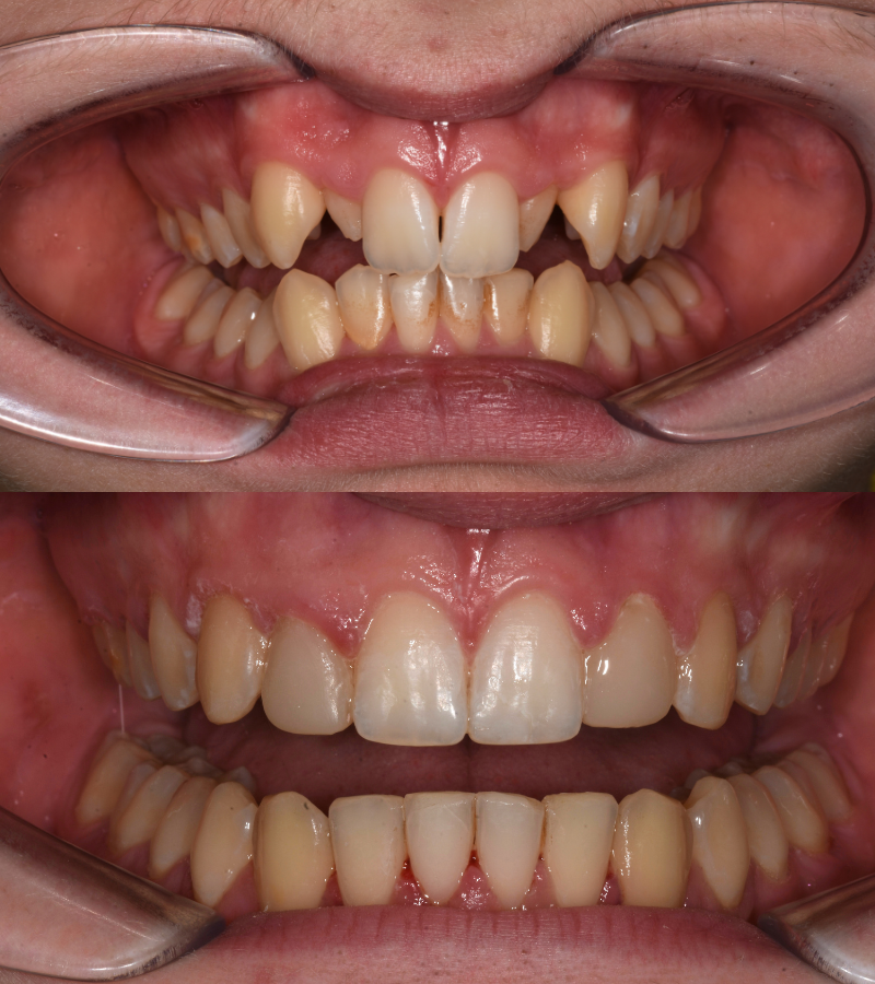 damon braces b&a 5