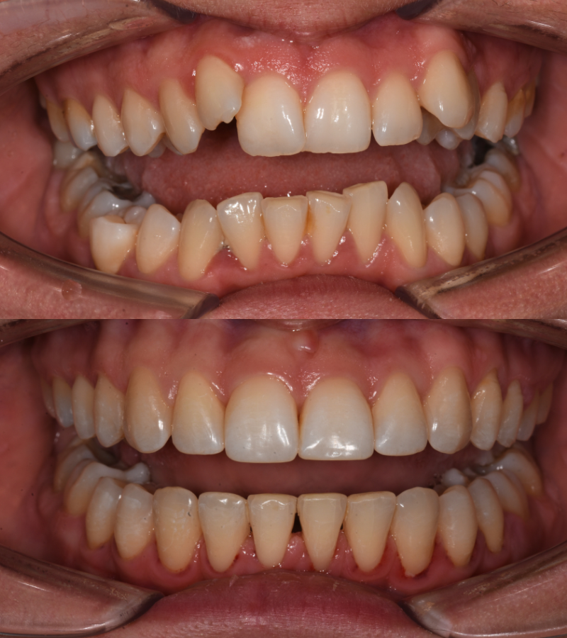 damon braces b&a 6