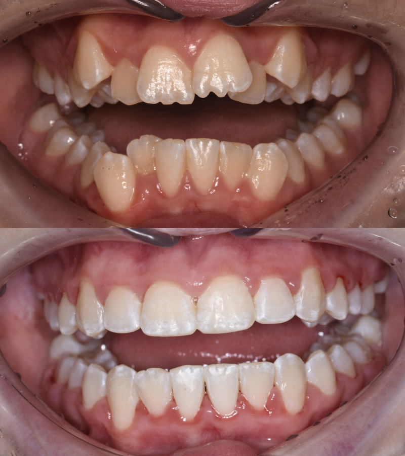 damon braces b&a 7