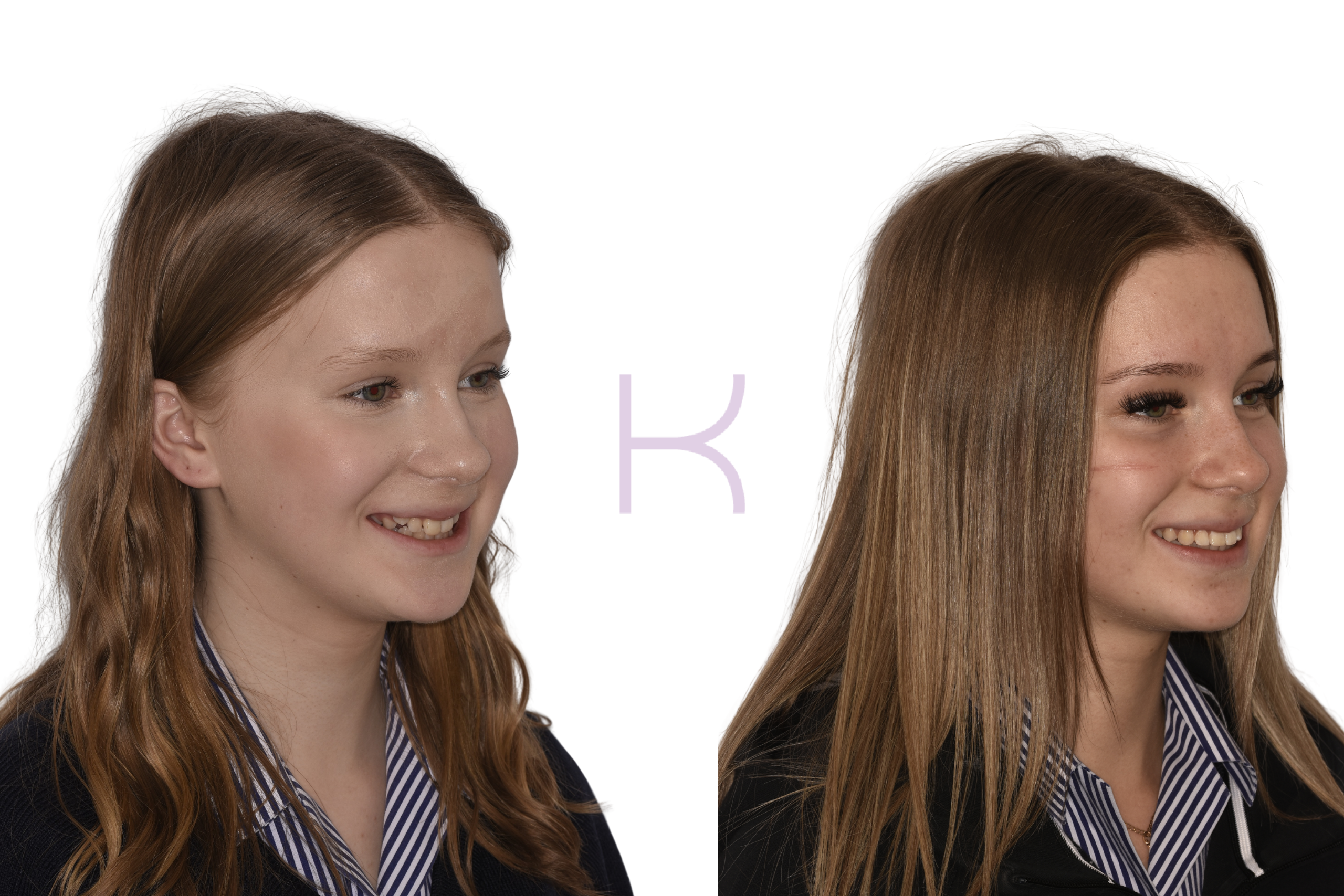 braces in knutsford beore and after results