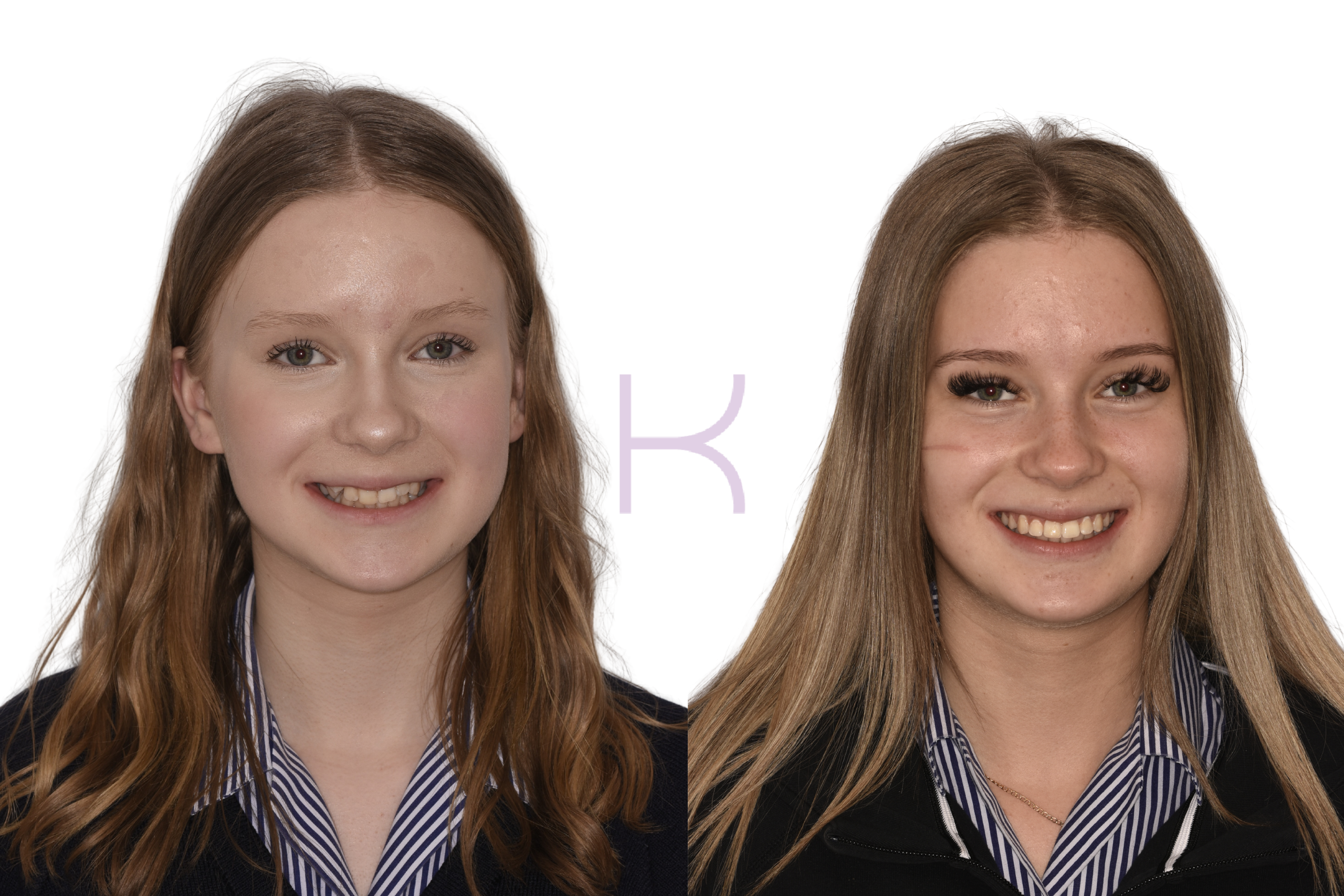 braces in knutsford beore and after results2