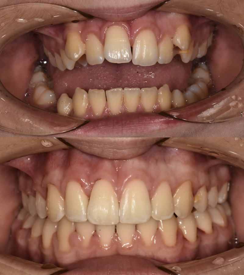 damon braces b&a