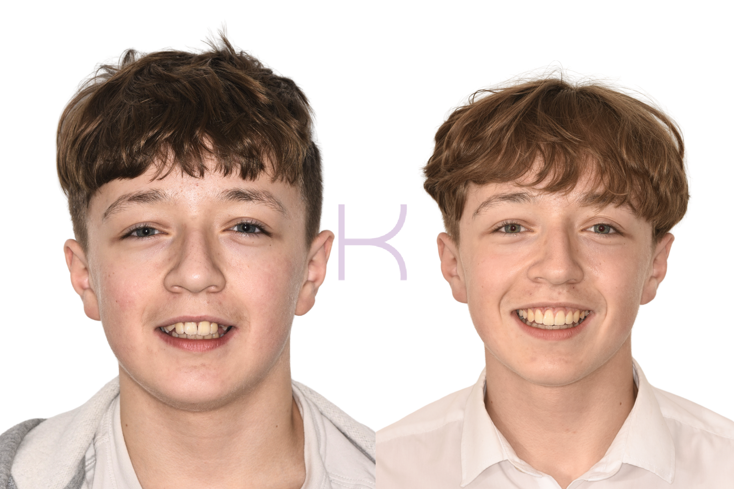 damon braces before and after in knutsford