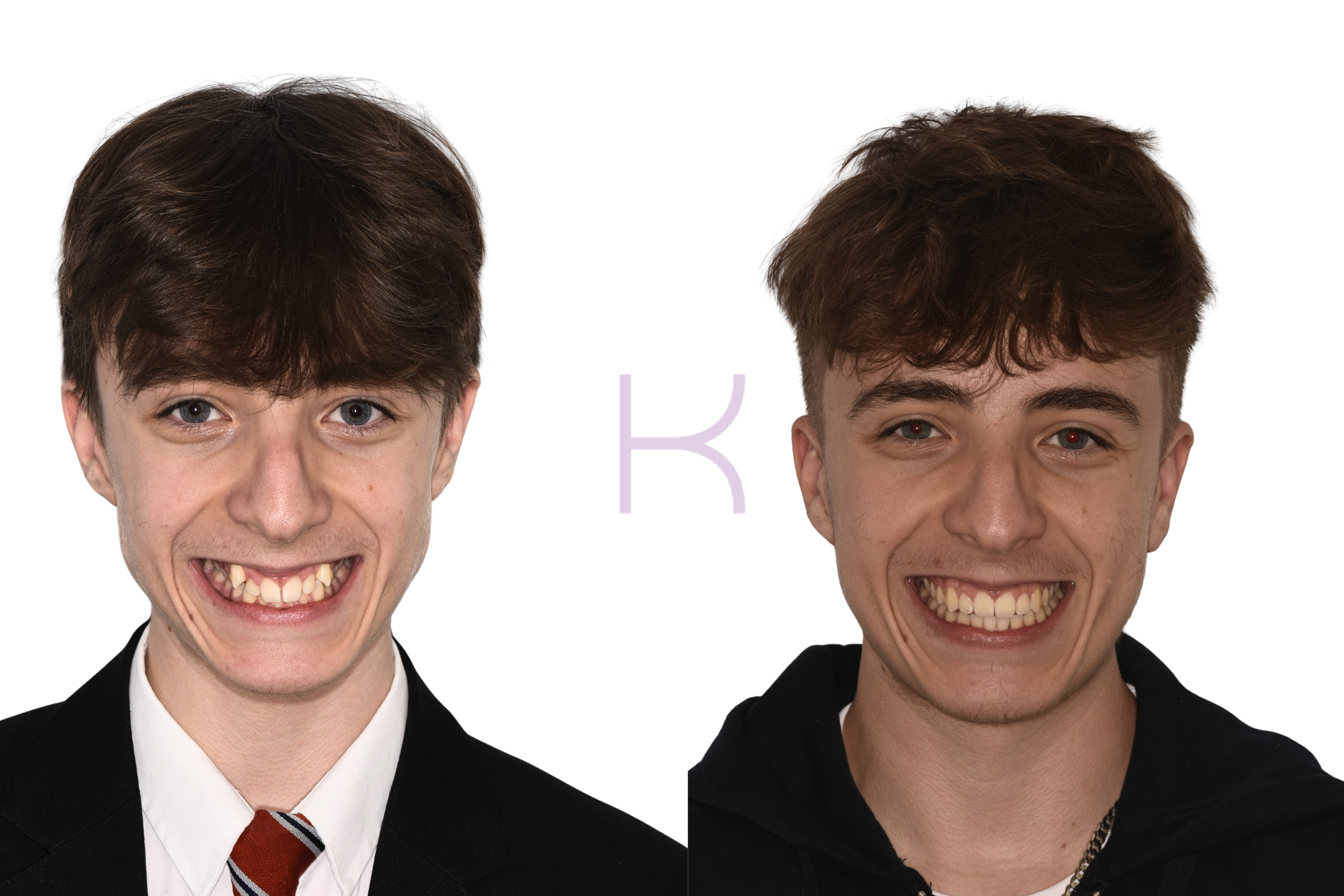 damon braces before and after knutsford (3)