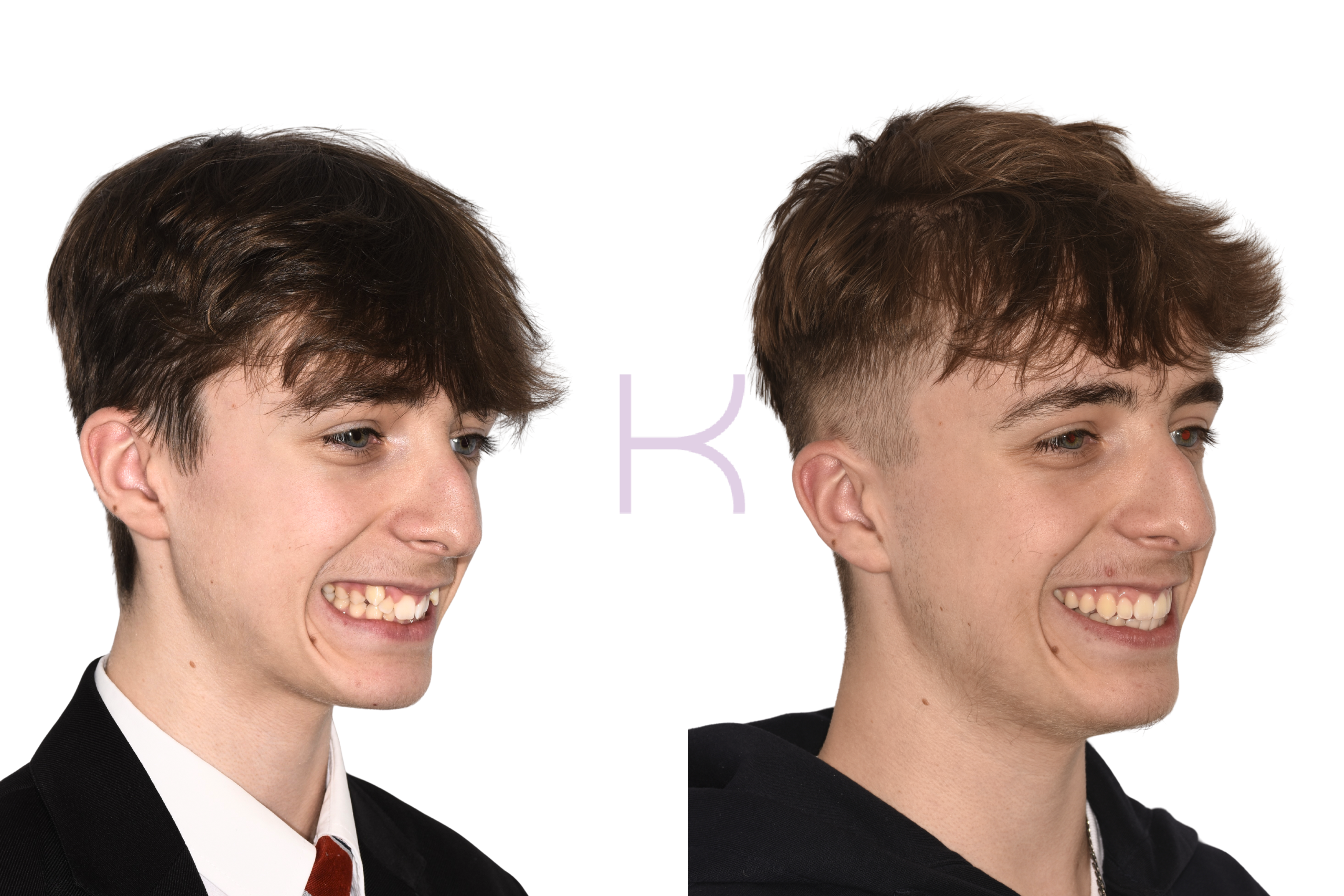 damon braces before and after knutsford (4)