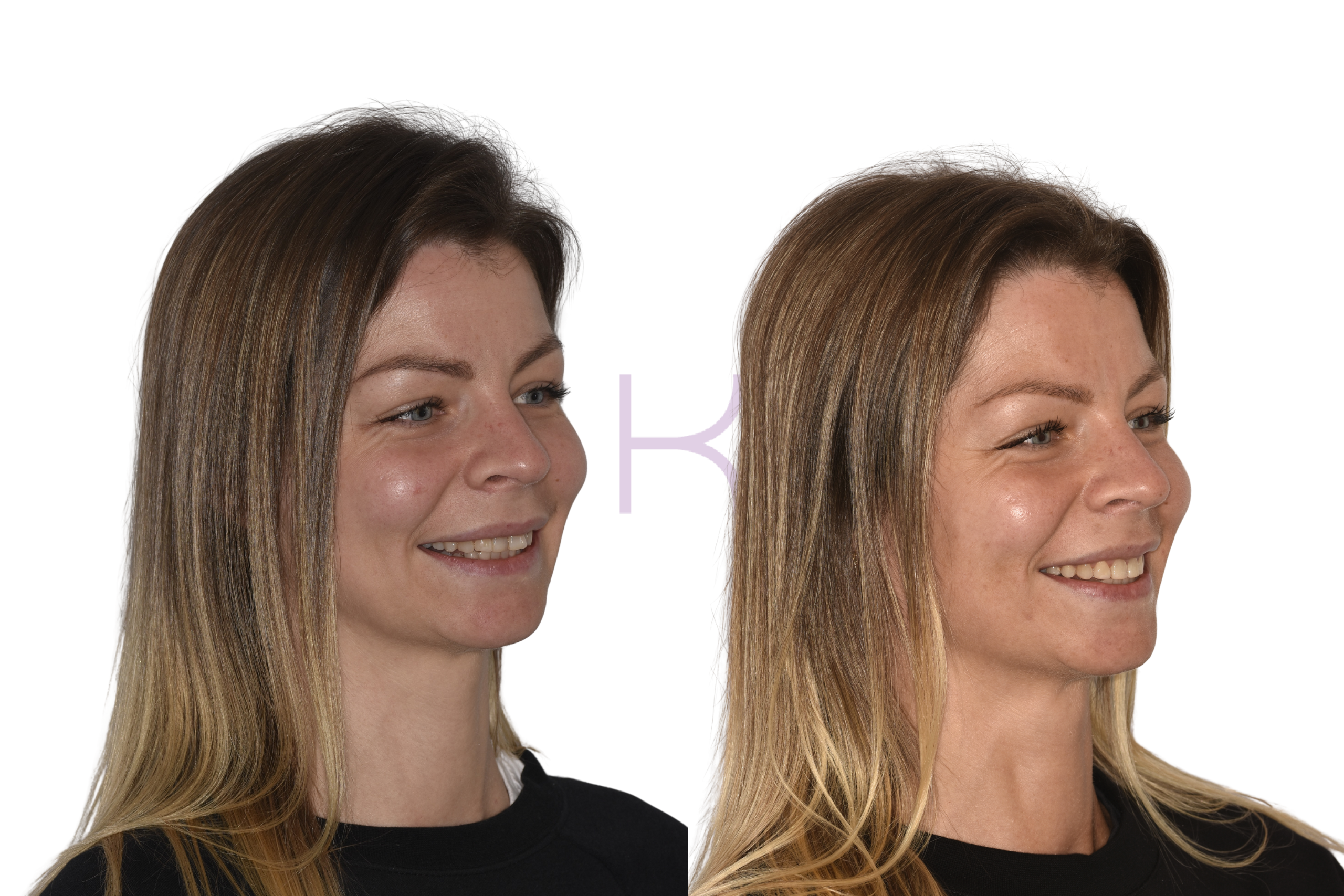 damon braces before and after knutsford (5)