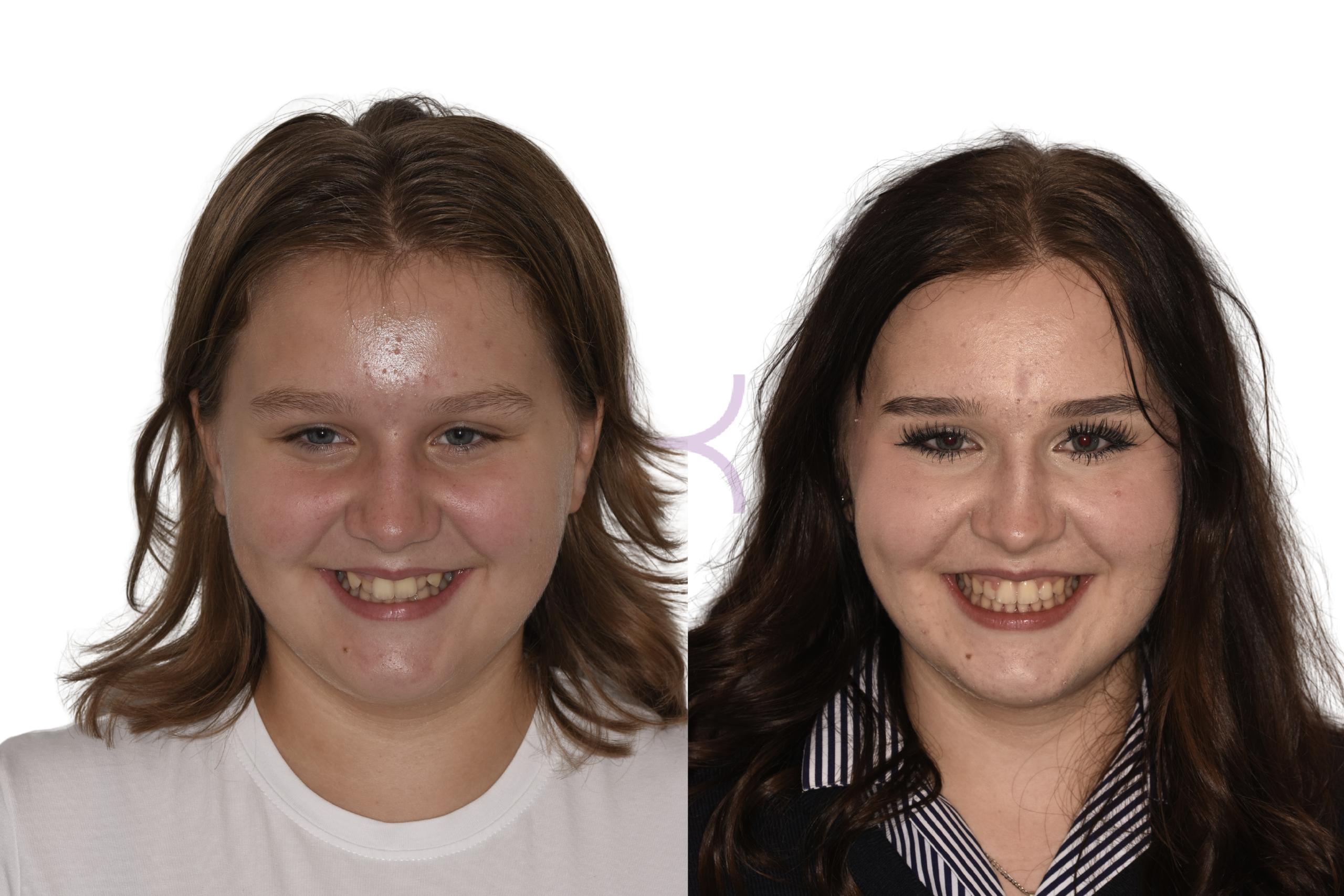 damon braces before and after knutsford (7)
