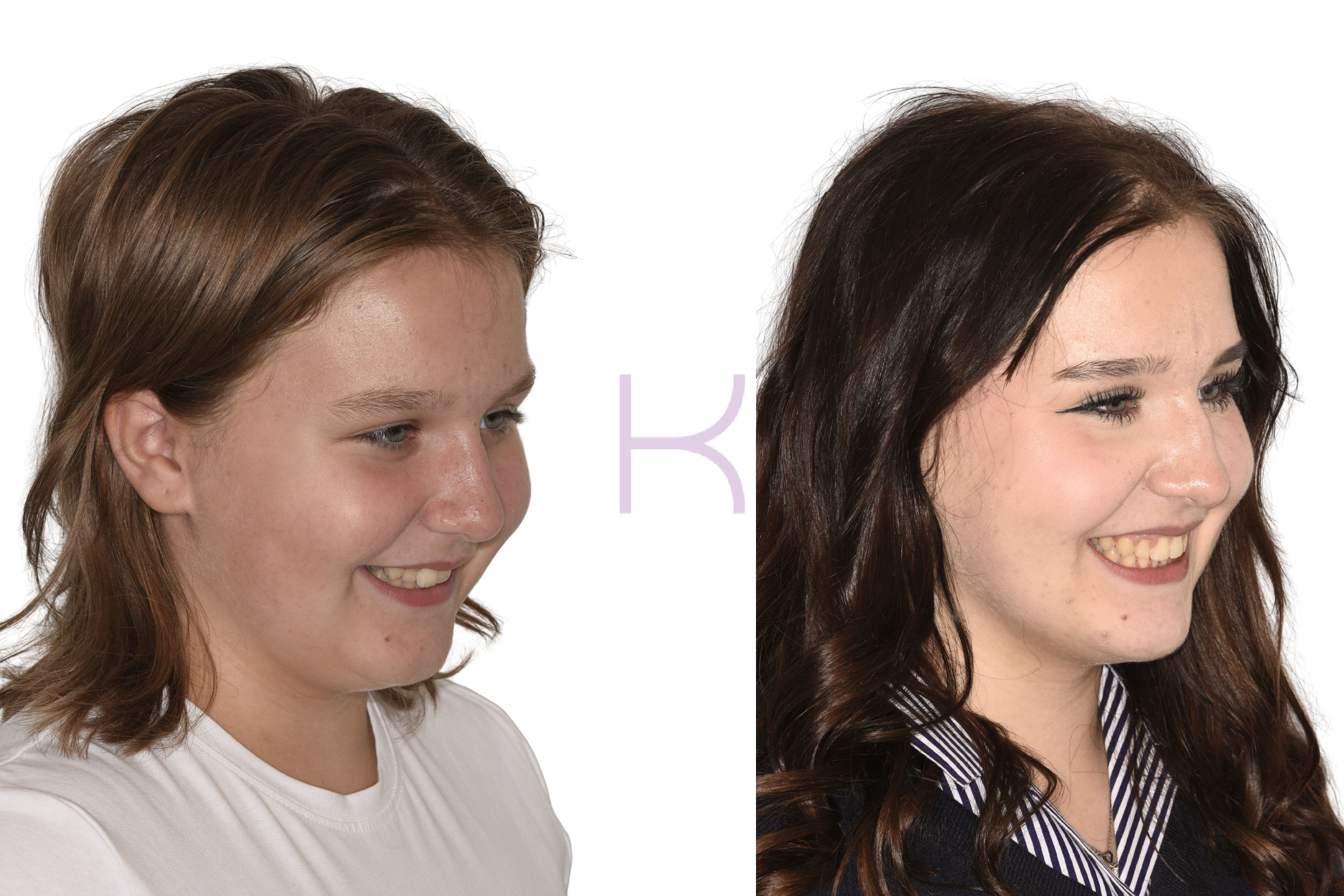 damon braces before and after knutsford (8)