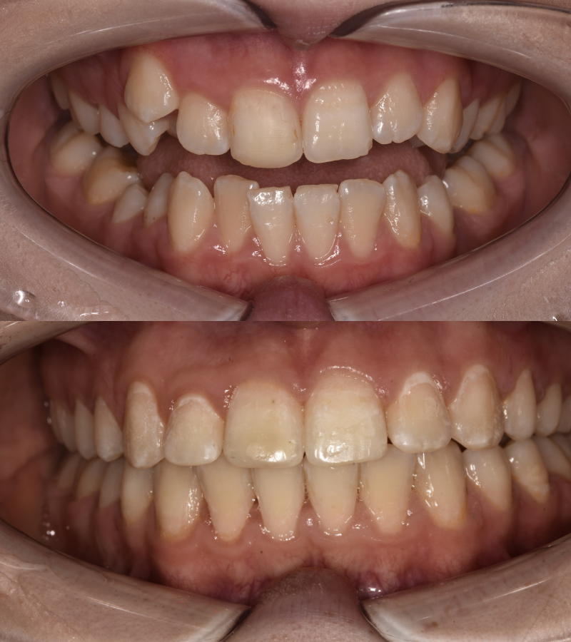 damon braces before&after in knutsford