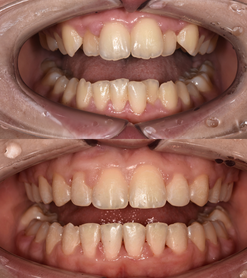 damon braces before&after