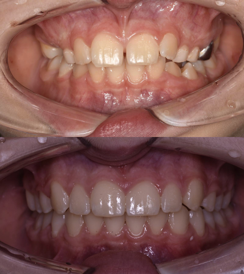 Angel aligners - before and after results