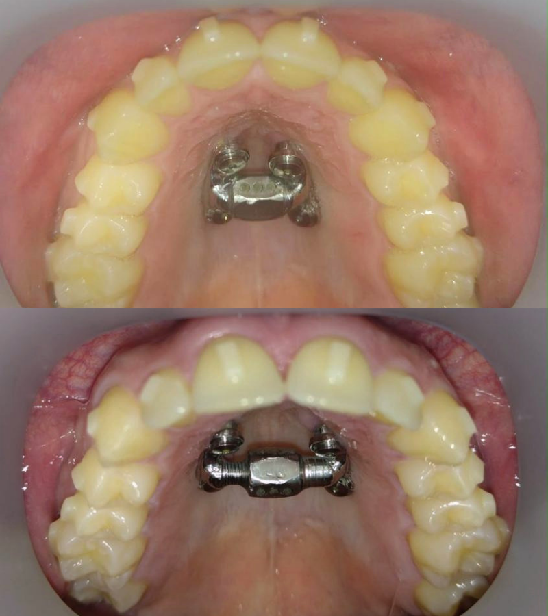 MARPE - before and after results 1