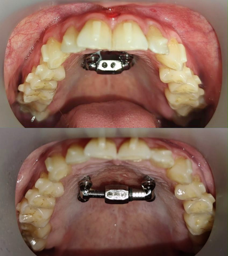 MARPE - before and after results 2