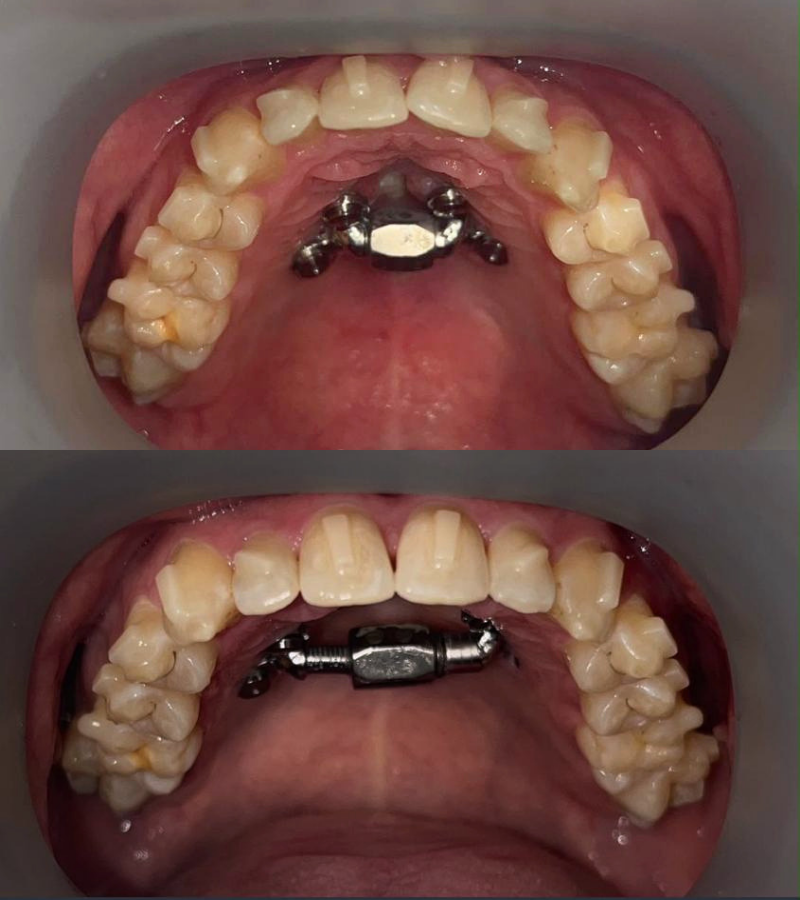 MARPE - before and after results 3