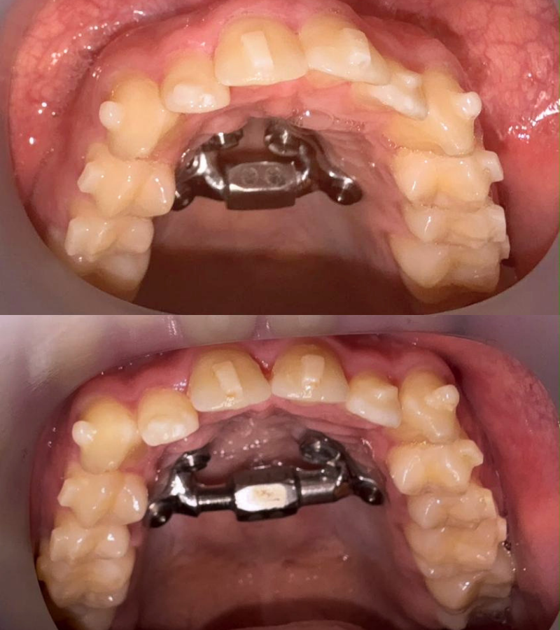 MARPE - before and after results 4